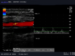 Ultrazvok žil nog - znižane hitrosti v golenični arteriji (a. tibialis posterior)